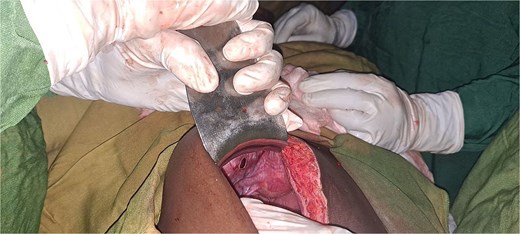 Intraoperative picture showing para-vesical defect.