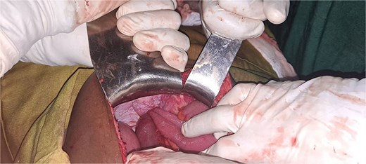 Intraoperative picture showing loop of incarcerated terminal ileum within the defect.