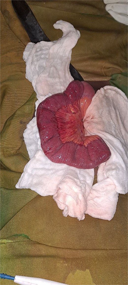 Intraoperative picture showing the herniated bowel after returning.