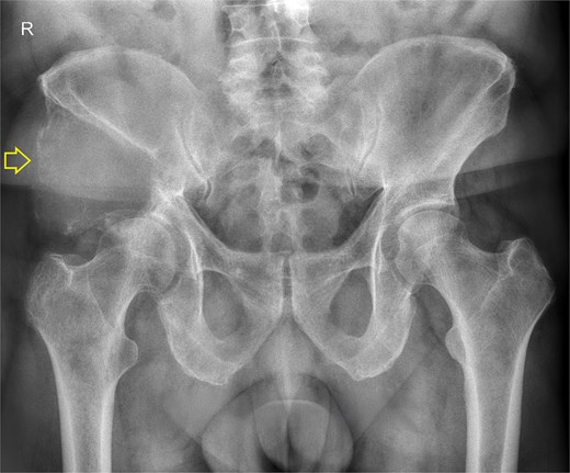 Pelvis radiograph, anterior view. A well-defined lytic lesion measuring 8 × 8 cm is identified in the right iliac wing.