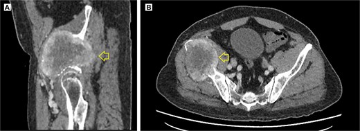Contrast-enhanced pelvic CT scan. (A) Sagittal view of tumor in iliac crest. (B) Axial view of the iliac crest. Expansile soft tissue mass (arrow) of 113 × 96 × 100 mm, with central necrotic degeneration and heterogeneous contrast enhancement but predominantly peripheral.