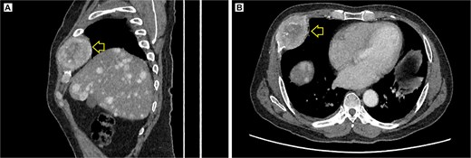 Contrast-enhanced thoracic CT scan. (A) Sagittal view showing the tumor on the chest wall, involving a rib. (B) Axial view showing the tumor in the right costal arch. Expansile soft-tissue mass (arrow) measuring 45 × 38 mm in the right costal arch, with central necrotic degeneration and heterogeneous peripheral contrast enhancement.