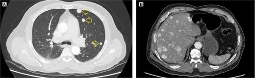 Contrast-enhanced thoracic and abdominal CT scan. (A) Axial view in the lung window of the thorax, solid hyperenhancing parenchymal nodules (arrow) ranging from 5 to 12 mm are observed in the left lung. (B) Coronal view in the soft tissue window, solid hyperenhancing nodules measuring 10 to 28 mm with diffuse distribution are observed.