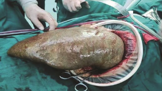 Surgical specimen.