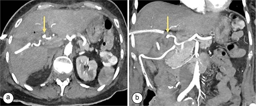 Angiotomography. (a) Axial slice showing a saccular image (arrow) with an aneurysmal appearance, 8 × 5 mm in size, originating from the right hepatic artery (Segment V), with no evidence of active bleeding. (b) Coronal slice showing a pseudoaneurysm (arrow) in the branch of the right hepatic artery (Segment V).