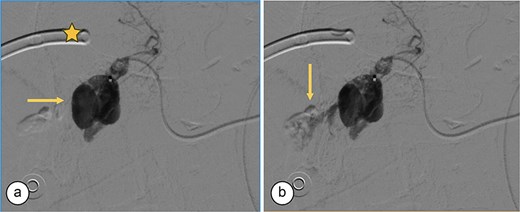Angiography. (a) Saccular image consistent with a hepatic artery pseudoaneurysm (Segment V). (b) Pre-embolization image of the right hepatic artery showing contrast medium leakage (arrow) from a branch (Segment V) of the right hepatic artery. Right percutaneous catheter (star).