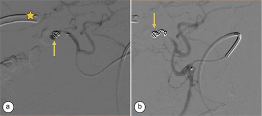 Transcatheter arterial embolization of the right hepatic artery. (a) Selective transcatheter arterial embolization (TAE) of the branch of the right hepatic artery (Segment V) (arrow). (b) Post-embolization image of the pseudoaneurysm in the branch (Segment V) of the right hepatic artery with microcoils (arrow), showing no contrast medium leakage. Right percutaneous catheter (star).