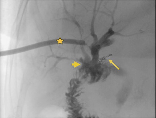 Supranastomotic percutaneous transcatheter cholangiography. Hepaticojejunostomy (arrowhead), microcoils (arrow), and percutaneous catheter (star).