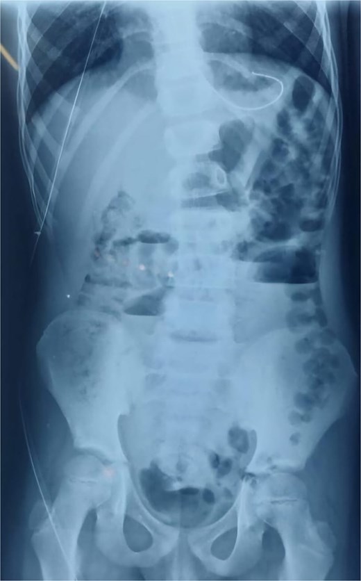 X-ray image at admission showing multiple dilated bowel loops with air-fluid levels.