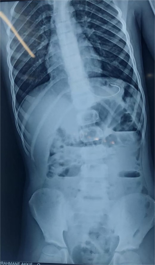 X-ray image after 6 h of admission, showing persistence of air-fluid levels.