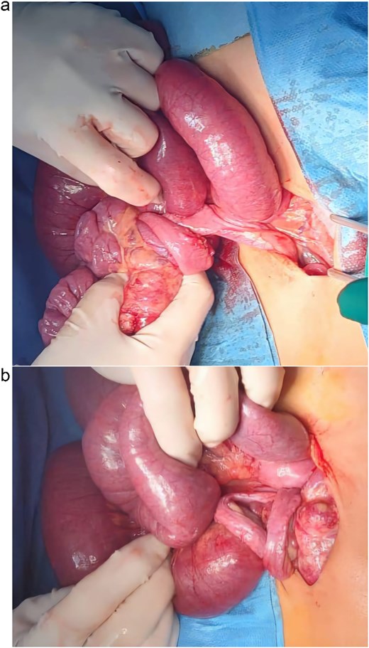 (a and b) Preoperative images showing the midgut volvulus found in the patient after exploration.