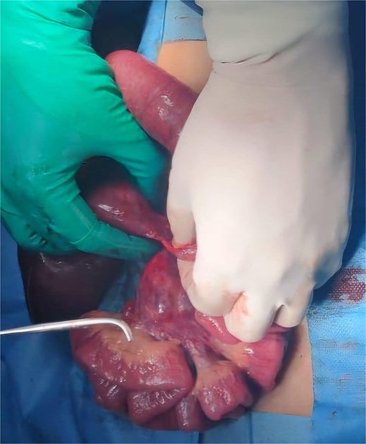 Preoperative image showing a Ladd band.