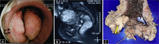 (A) Sigmoidoscopy showing a polypoidal growth with surface ulceration (arrow) in the rectum involving more than 2/3 of the circumference. (B) CE MRI pelvis in a T2-weighted sequence reveals a heterogeneously enhanced hyperintense lesion with transmural involvement reaching up to the muscularis propria. (C) Gross specimen of proctosigmoidectomy showing a pedunculated polyp with petechial hemorrhages (arrow).