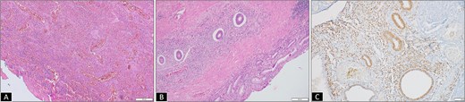 (A) Micrograph from initial rectal polyp biopsy showing complete mucosal ulceration with underlying inflammatory granulation tissue (H&E 100×). (B) Micrograph from resection specimen showing colonic mucosa with ectopic endometrial glands and stroma traversing transmurally from the lamina propria to muscularis propria (H&E 200×). (C) Endometrial glands and stroma highlighted by estrogen receptor (ER, IHC 200×).