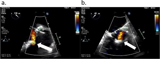 TEE showing a leak (arrows) from the Inspiris Resilia valve in the aortic position after the first aortic cross-clamp was removed. (a) Long axis view. (b) Short axis view.