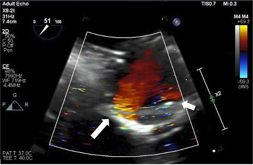 TEE demonstrating two leaks from the Inspiris Resilia valve after the second aortic cross-clamp was removed. A larger now broad-based, moderate or greater regurgitant leak at the non/right commissure (long arrow), and a new mild leak along the left/right commissure (short arrow).