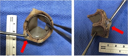 Gross images of the Inspiris Resilia valve showing a small gap (arrows) of the torn fabric between the stent posts and the sewing ring.