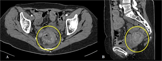 Abdominal CT showing a mass in the rectum: (A) axial scan, (B) sagittal scan.