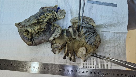 Gross appearance of the removed specimen.