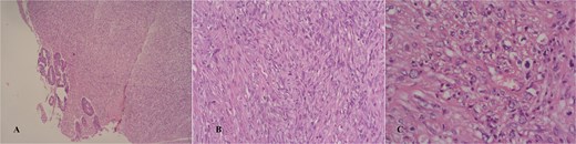 Hematoxylin/eosin stain showing an infiltrative spindle cell neoplasm sparing the mucosa in a glance (A and B), high power field showing mild nuclear pleomorphism (C).