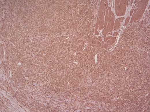 Positive staining for SMA.
