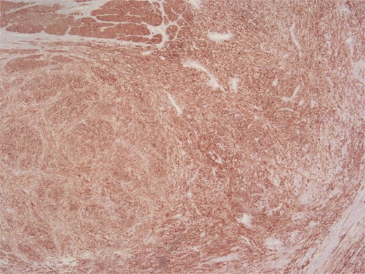 Positive staining for caldesmon.