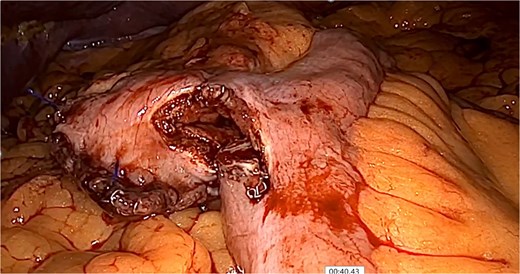 Isoperistaltic, antecolic, and side-to-side gastrojejunostomy is performed.