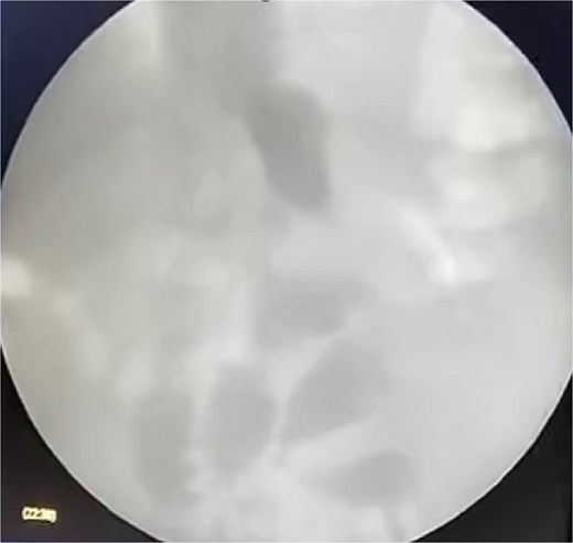 Fluoroscopy performed at 24 hours showing intraluminal contrast without leakage.
