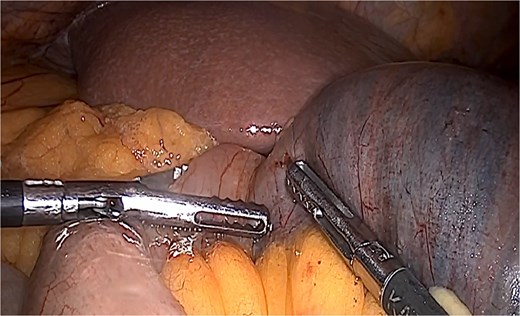 Biliopancreatic loop dilation.