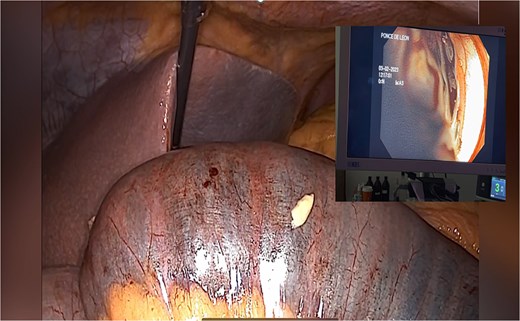 Endoscopy shows hemobezoar at the site of gastrojejunal anastomosis.