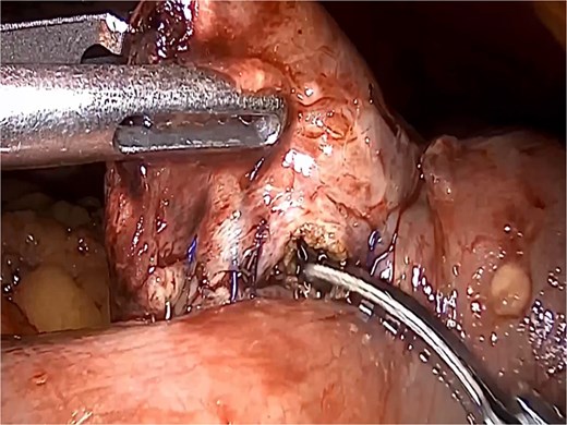 Removal of enterostomy suture.