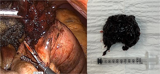 Hemobezoar removal.