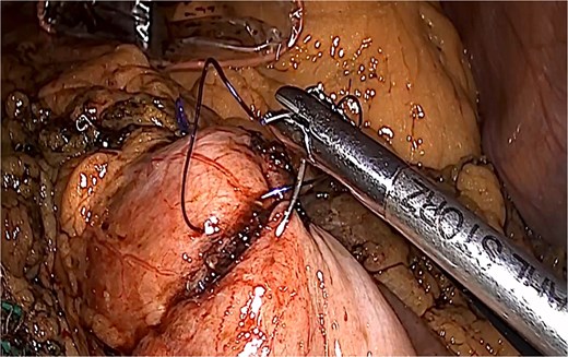 Closure of enterostomy in two planes.