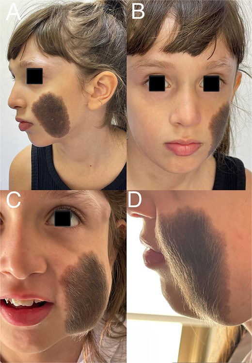 (A) Patient photograph (frontal view). (B) Patient photograph (lateral view). (C) Patient photograph after full expansion of the tissue expander (frontal view). (D) Patient photograph after full expansion of the tissue expander (lateral view).