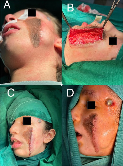 (A) Patient appearance prior to the third surgical stage. (B) Surgical incision site. (C) Operative field at the end of the third surgical procedure. (D) Lateral view of the patient prior to the final surgical stage.