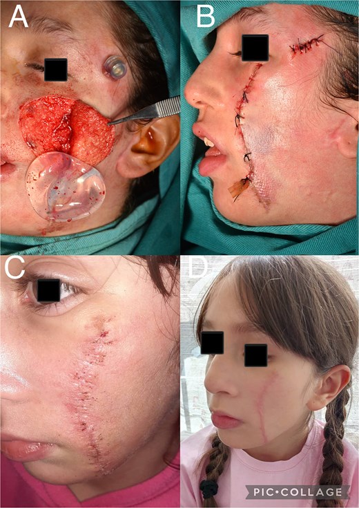 (A) Intraoperative view showing complete excision of the nevus and removal of the tissue expander. (B) Lateral view of the patient at the completion of the final surgical stage. (C) Postoperative view of the patient after removal of surgical sutures. (D) Postoperative view of the patient six months after surgery.
