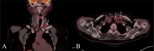 PET CT with coronal (A) and axial (B) images showing enlarged and hypermetabolic level IV and VI lymph nodes with no primary malignancy identified.