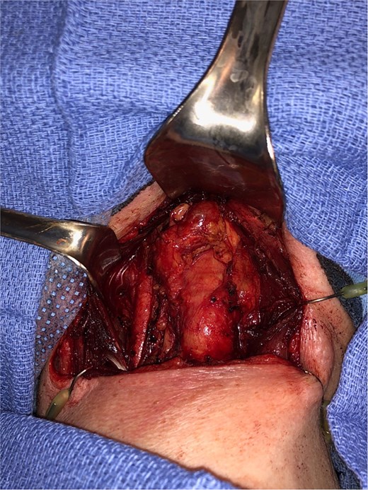 Intraoperative image, demonstrating a central level 6 neck mass medial to the thymus, following total thyroidectomy.