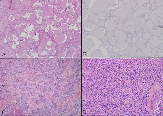 (A) Thyroid gland on low power H + E (4×) photomicrograph showing a representative section of unremarkable thyroid gland. The entire gland had a similar appearance. (B) Thyroid gland calcitonin stain (20×) image showing the thyroid proper is negative for calcitonin. Several calcitonin stains were performed and all were negative excluding C cell hyperplasia and primary medullary carcinoma. (C) Left level 4 lymph node with low power H + E (4×) photomicrograph demonstrating a lateral neck node replaced by tumor. The tumor has a paraganglioma-like appearance with uniform cells in a nested pattern. (D) Left level 6 lymph node with low power H + E (4×) photomicrograph demonstrating a central neck node, replaced by tumor. The tumor has a more classic appearance of medullary thyroid carcinoma here with evident spindle cell morphology.