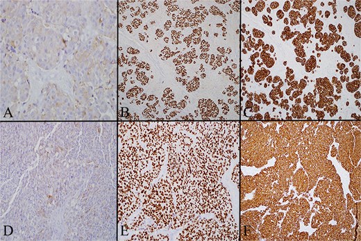 (A) Left level 4 lymph node stained for calcitonin on high power (20×), which demonstrates that in the lateral neck node tumor cells have cytoplasmic expression of calcitonin. (B) Left level 4 lymph node stained for TTF1 on low power (4×) showing that in the lateral neck node the tumor cells are diffusely positive for TTF. (C) Left level 4 lymph node stained for cam 5.2 on low power (4×) showing that in the lateral neck node the tumor cells are diffusely positive for cam 5.2 (pancytokeratin). (D) Level 6 lymph node stained for calcitonin on high power (20×) showing that the central neck node tumor cells have cytoplasmic expression of calcitonin. (E) Level 6 lymph node stained for TTF on low power (4×) showing that the central neck node tumor cells are diffusely positive for TTF. (F) Level 6 lymph node stained for cam 5.2 on low power (4×) showing that the central neck node tumor cells are diffusely positive for cam 5.2 (pancytokeratin).