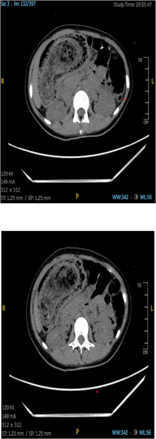 Multislice thin-cut noncontrast axial plane CT of the abdomen.