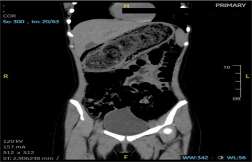 Coronal plane CT of the abdomen.