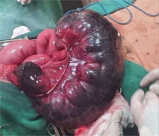 Illustration of a markedly distended cecum, demonstrating significant enlargement and clear signs of obstruction.