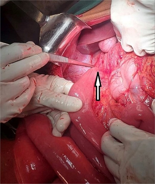 The DJJ abnormally located in the right upper quadrant. Ladd’s band is indicated by the arrow.