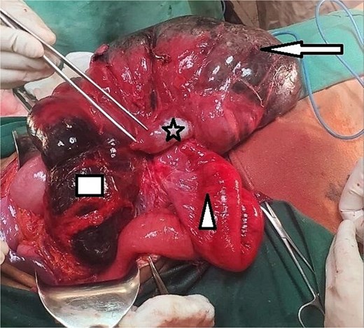 Grossly distended and detorsed cecum marked by an arrow, showing signs of severe dilation. The ileum, indicated by a triangle, appears edematous but remains viable. The appendix is identified by a star, while the ascending colon, outlined by a rectangle, shows clear signs of gangrene with necrotic tissue changes.