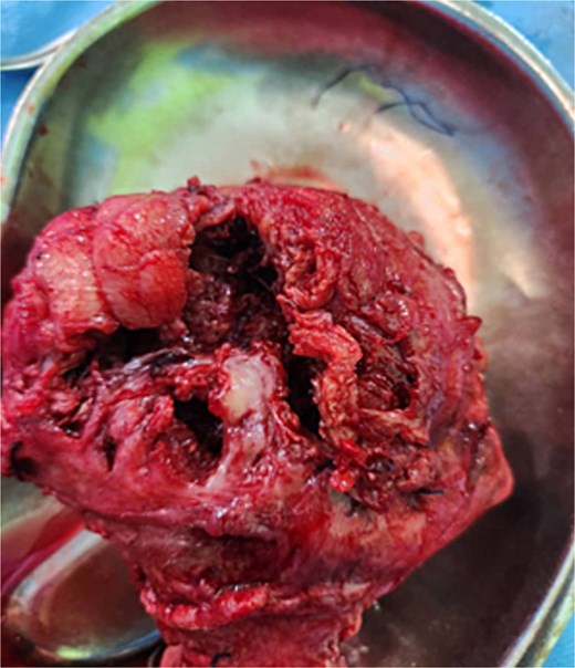Extensive ragged rupture at the anterior aspect of the uterus.