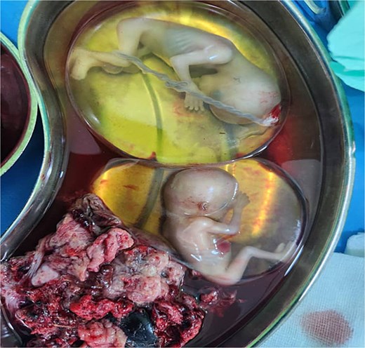 Fetuses in intact gestational sacs after removal from the ruptured uterus.