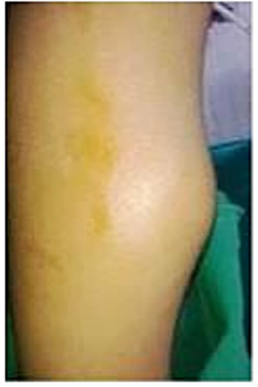 Clinical picture of the patient's left leg showing swelling on the medial aspect.