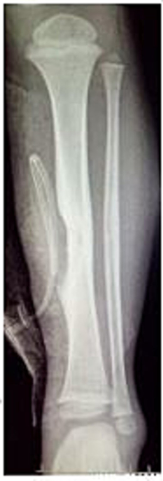 Radiograph showing erosion of tibia beneath pseudoaneurysm.