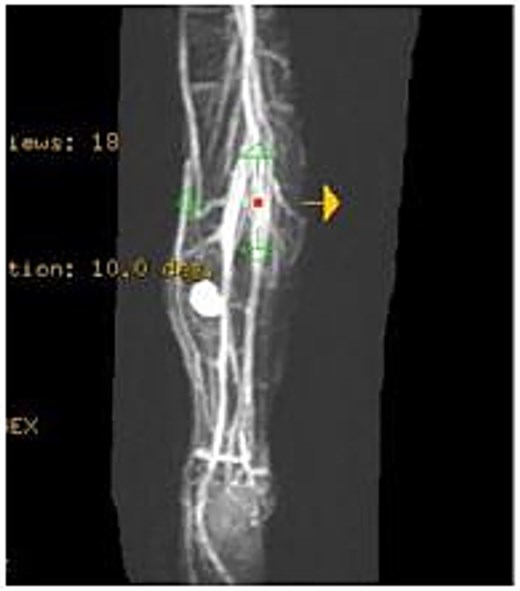 MRA showing the pseudoaneurysm arising from an unnamed branch of the posterior tibial artery.